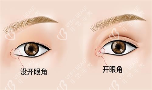 开眼角前后对比图