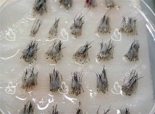 毛囊照片