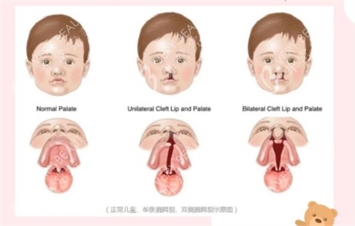 唇腭裂不同程度