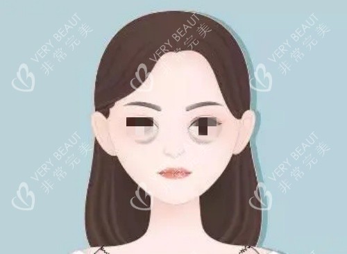 泪沟漫画示意图