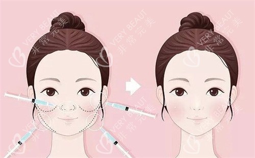 石家庄美莱整形2025价格表查询：全切双眼皮2625元起、缩鼻翼9882元起、超声炮8732元起