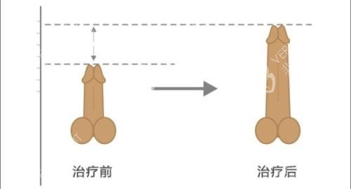 陰莖增長手術(shù)前后長度對比動畫圖