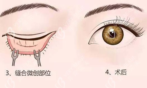 义乌秀壹内切祛眼袋展示图
