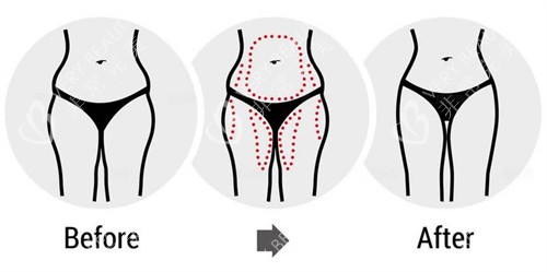 腰腹大腿吸脂前后对比图