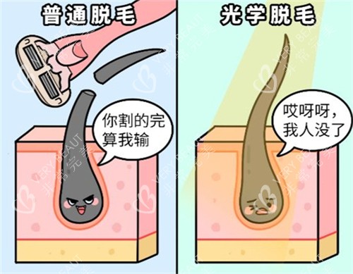 激光脱毛和普通刮毛的区别