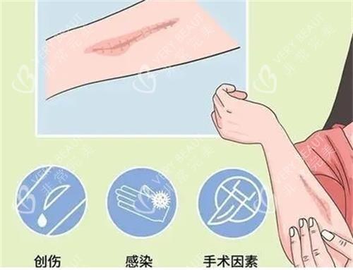 疤痕增生因素圖