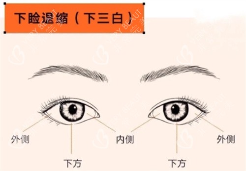深圳朱辉眼修复下睑退缩