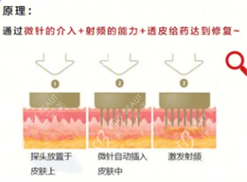 黃金微針原理分析
