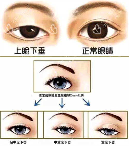 上瞼下垂的不同程度