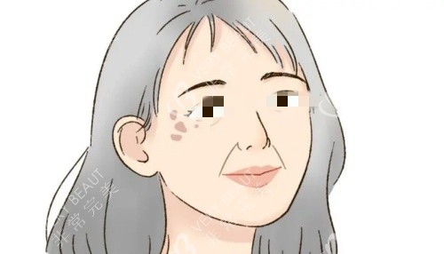 真皮斑漫畫示意圖