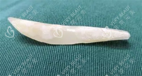 隆鼻假体图片