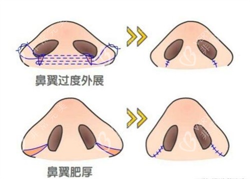 鼻翼缩小手术对比