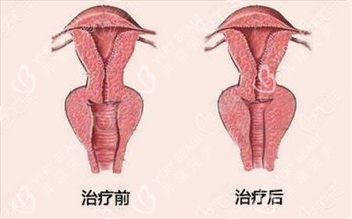 女性阴道紧缩手术前后对比动画图