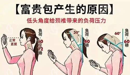 富贵包产生的原因
