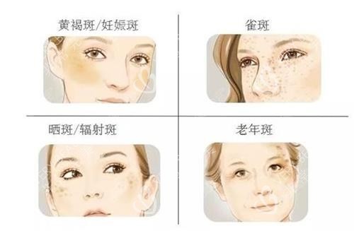 雀斑的種類