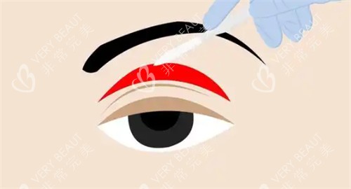上瞼下垂手術(shù)操作過程