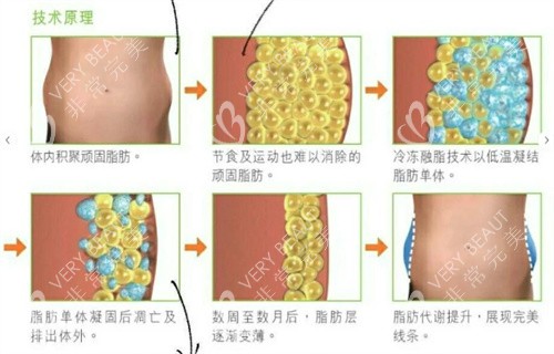 酷塑冷冻溶脂