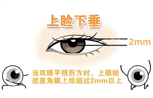 判斷是否上瞼下垂圖示