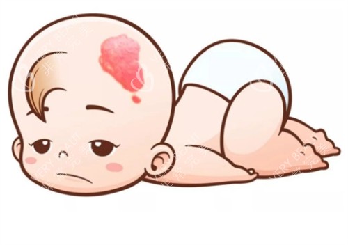 新生兒鮮紅斑痣