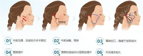 微拉美拉皮手術(shù)過程圖