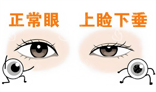 正常眼和下垂眼對比
