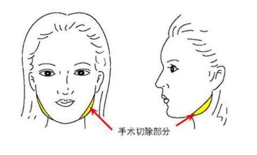 面部磨骨手術(shù)示意圖