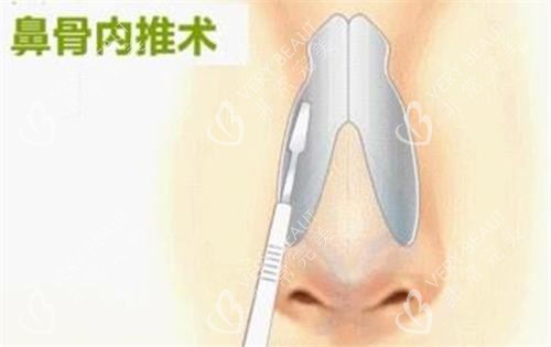 鼻骨内推手术示意图