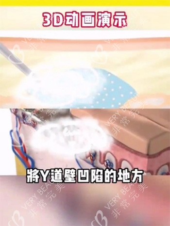 紧缩针注射阴道动画图