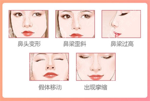武汉杨水斌鼻整形图示