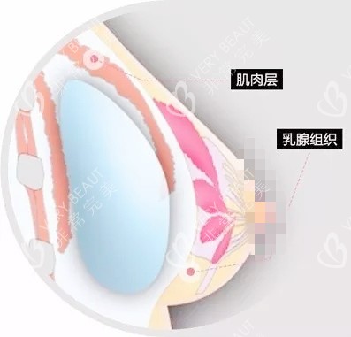 雙平面豐胸