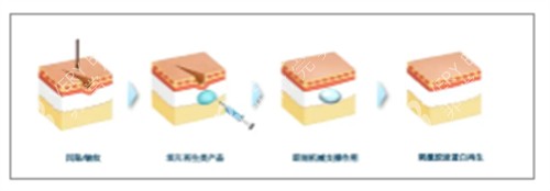 童顏針注射前后對比圖解