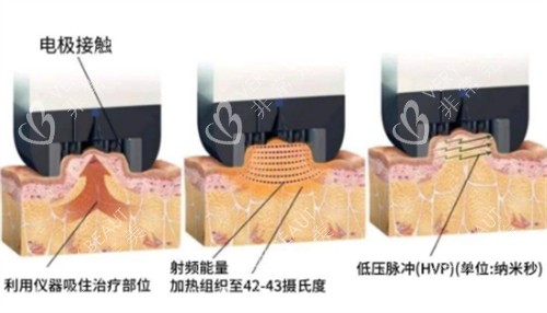 钻石超塑的原理图解