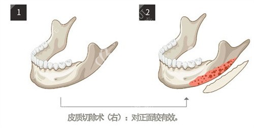下頜角削骨