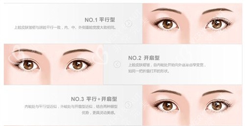 雙眼皮的類型