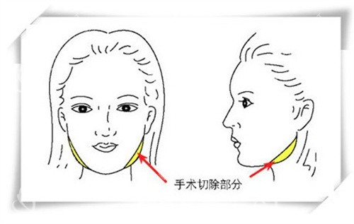 我的磨骨经历：术后会比一般人老得快吗？医生保留骨骼支撑力，衰老与护理更相关