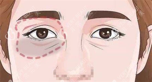 淚溝眼袋畫線展示圖