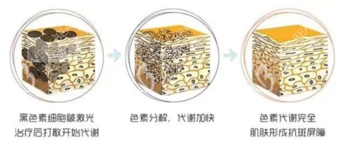 激光祛斑的原理