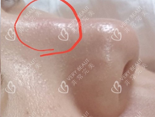 隆鼻炎癥透光圖片