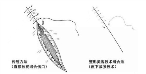 減張縫合手術(shù)