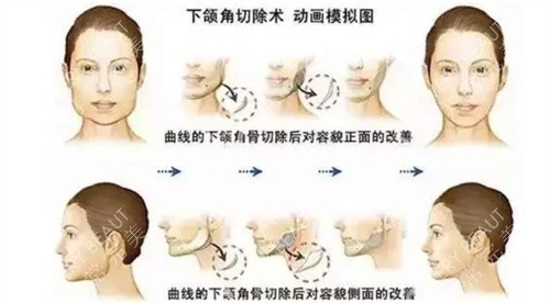 下頜角整形對比