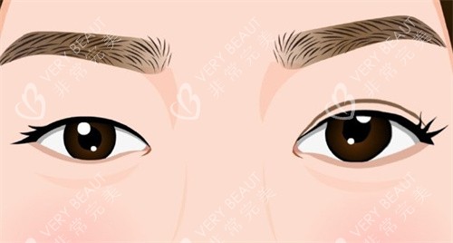 雙眼皮手術(shù)術(shù)前術(shù)后對比卡通