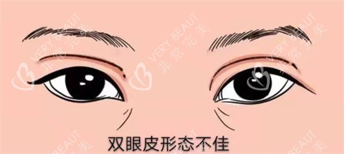 雙眼皮修復(fù)示圖