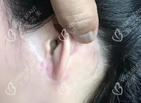 拉皮手術(shù)疤痕圖