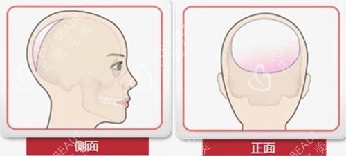 后脑勺整形手术