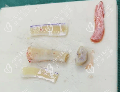 肋骨隆鼻材料