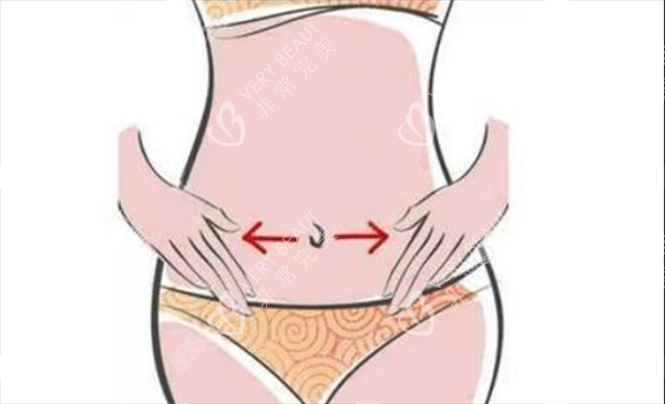 腹壁成形術2