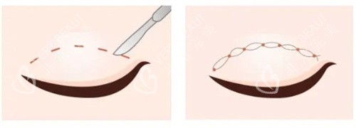 雙眼皮切開vs雙眼皮埋線