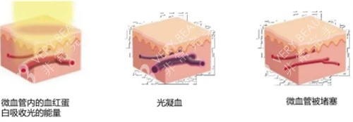 595染料激光治疗过程图解
