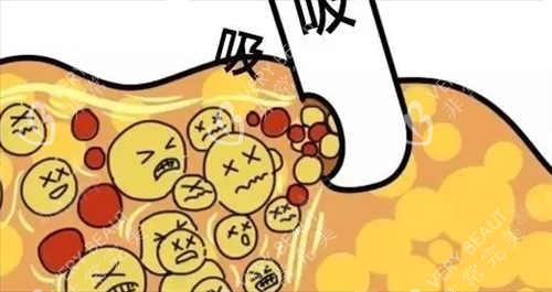 吸脂过程动画展示图