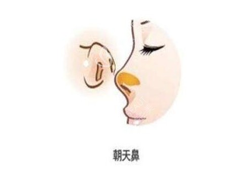 深圳寶麗朝天鼻整形手術(shù)